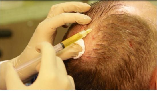 Плазмотерапия Endoret (prgf)/ Эндорет  в трихологии – действенный способ в решении проблем истончения и выпадения волос.