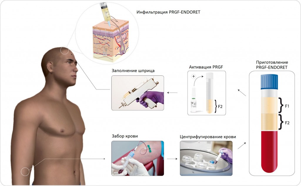 Протокол процедуры плазмотерапии Endoret PRGF (PRP-терапия, плазмолифтинг)
